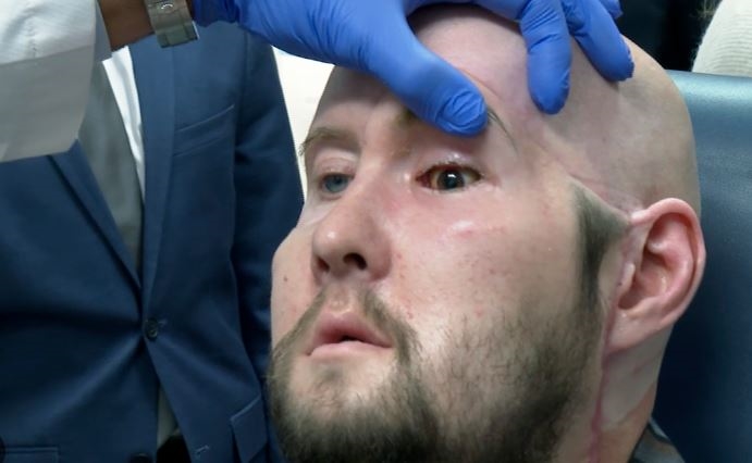 દુનિયામાં પહેલીવાર ડૉક્ટરોએ માનવીનું સંપૂર્ણ Eye Transplant કર્યું, અમેરિકામાં 21 કલાક ચાલી સર્