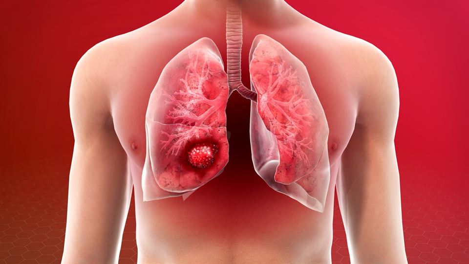 World Lung Cancer Day 2024: સ્મોકિંગ કરવાથી દર વર્ષે કેટલા લોકોને થાય છે લંગ કેન્સર?