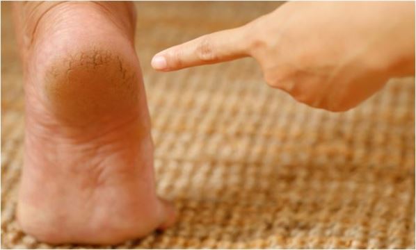 શું તમે પણ શિયાળામાં પગની ફાટેલી એડીથી પીડાવ છો? તો આ ઉપાય છે તેના અસરકારક ઈલાજ! આજે જ અજમાવો.