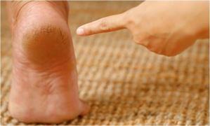 શું તમે પણ શિયાળામાં પગની ફાટેલી એડીથી પીડાવ છો? તો આ ઉપાય છે તેના અસરકારક ઈલાજ! આજે જ અજમાવો.