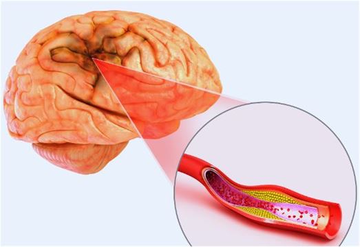 સ્ટ્રોકના શરૂઆતી લક્ષણ